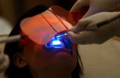 Laser-Zähne Bleaching-in weniger als einer Stunde
